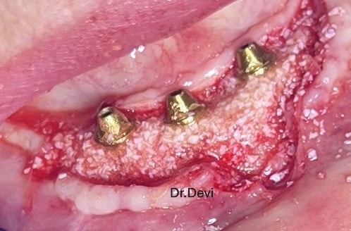 Implant placement with bone grafting