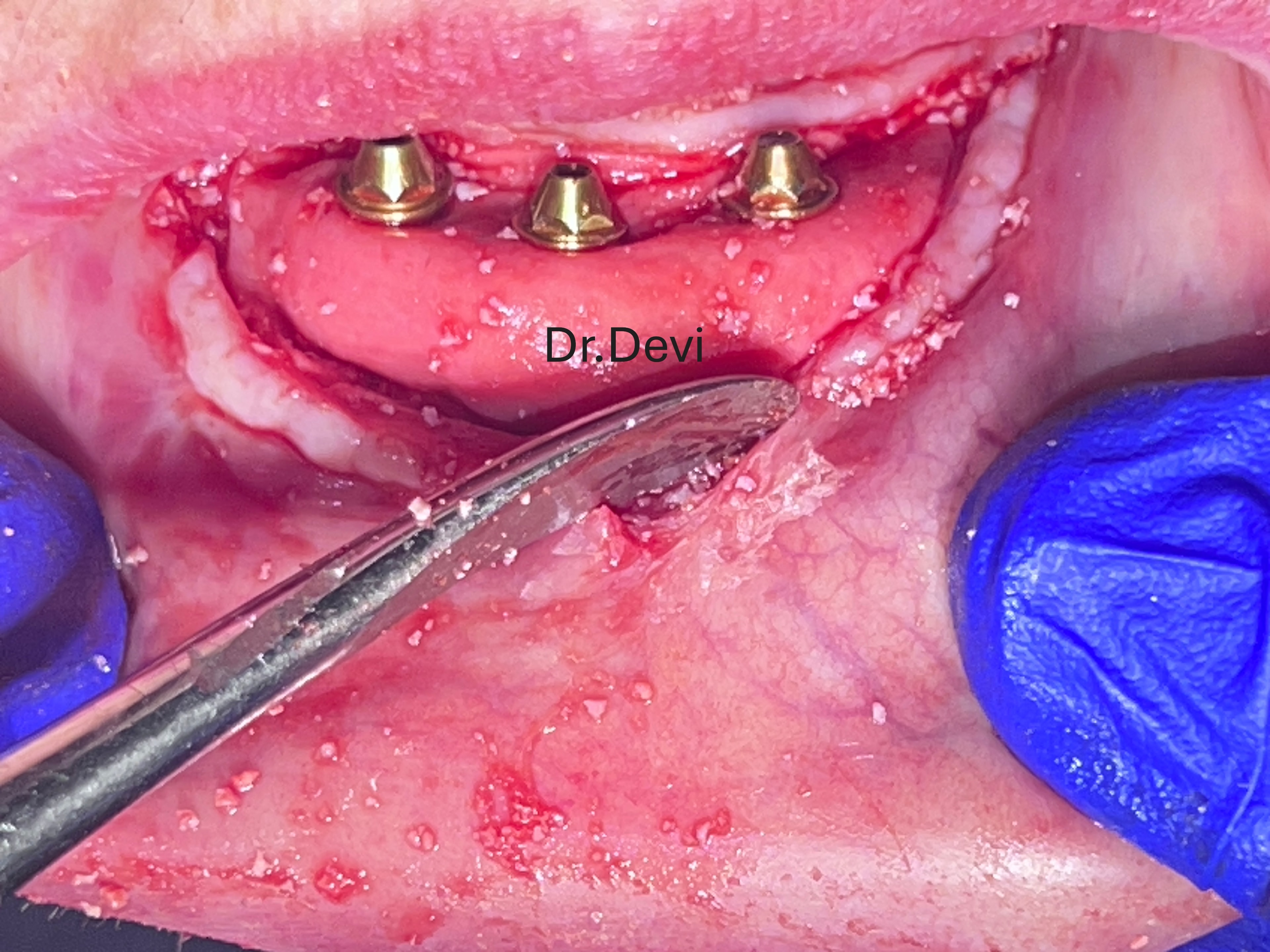 Collagen membrane protection of bone graft