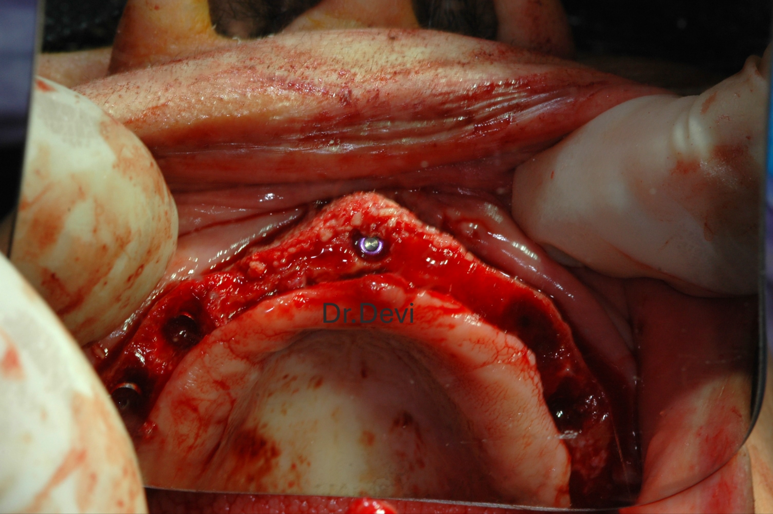 Reconstructing upper jaw with bone graft