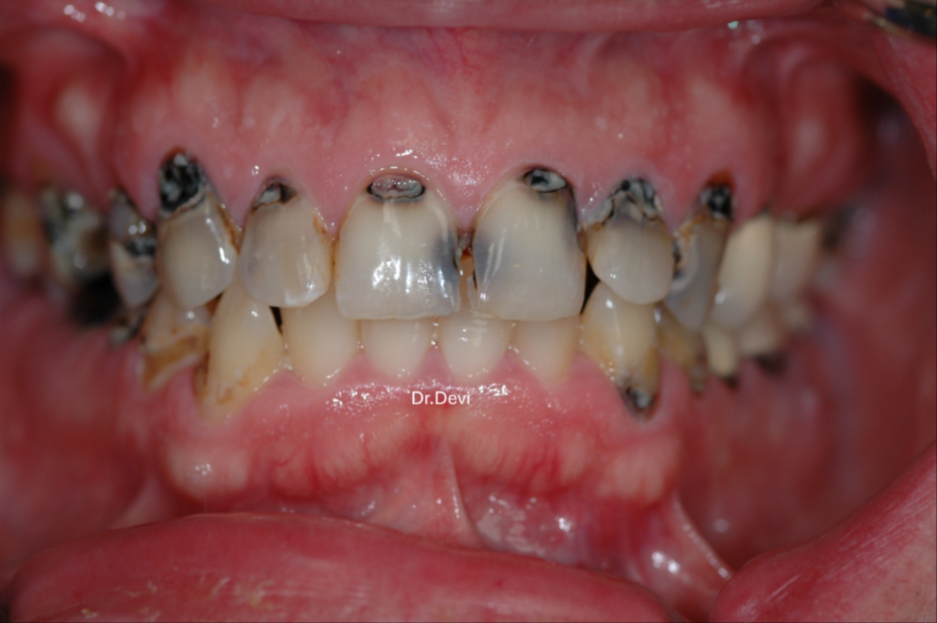 Dentist consulting with patient about All-on-4 implants