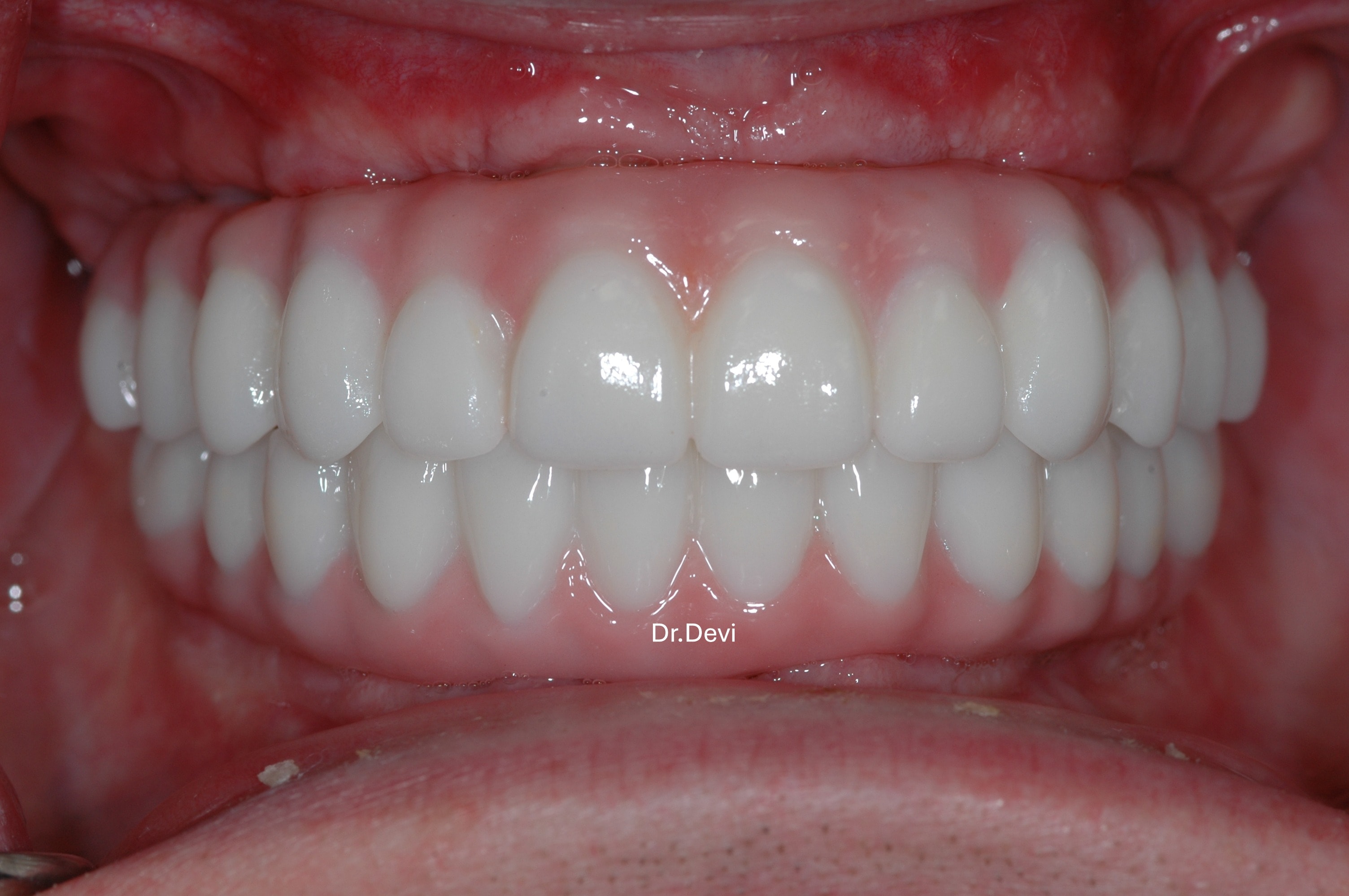 All-on-4 dental implant procedure