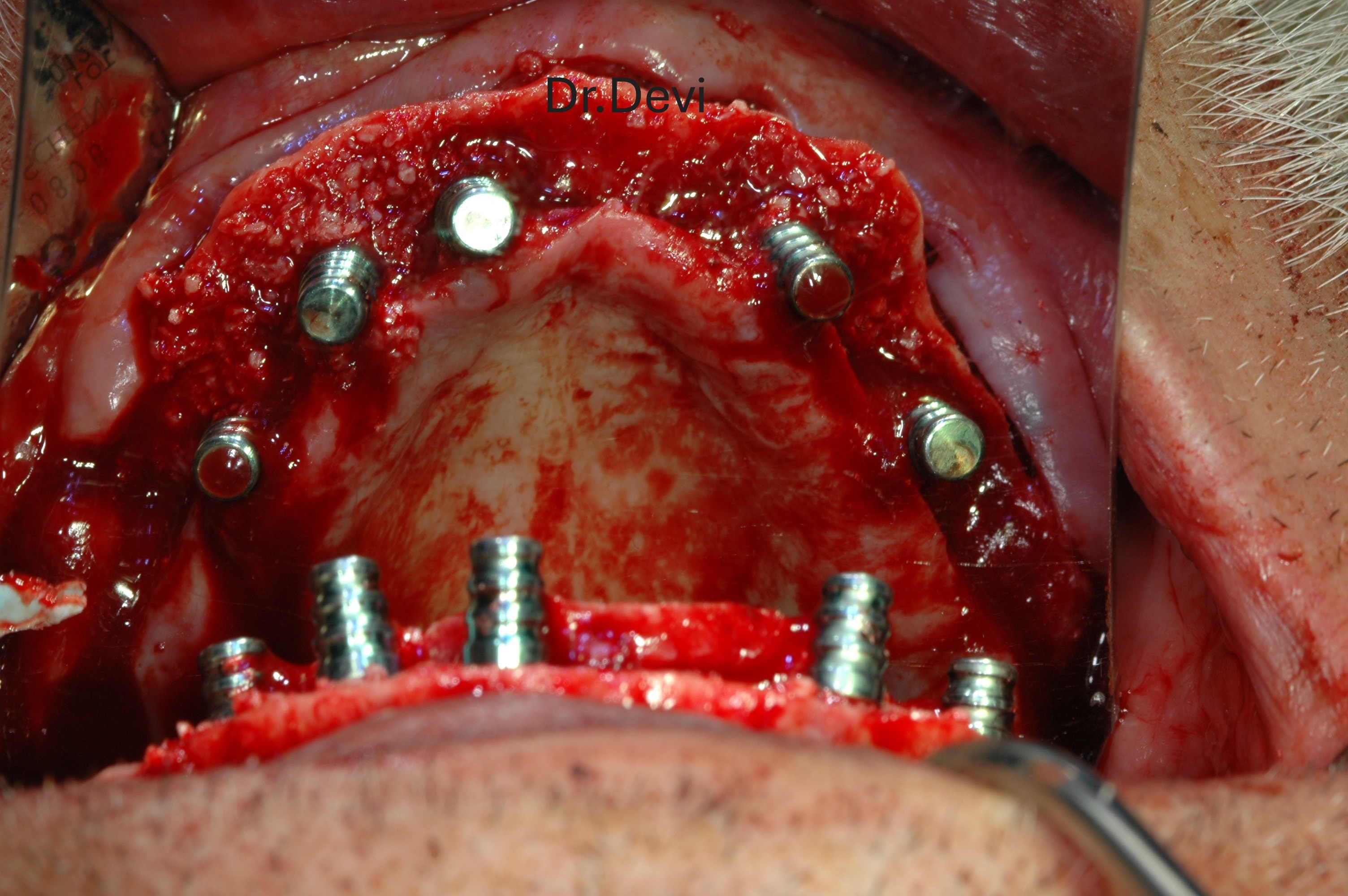 Extraction & socket grafting during All-on-4