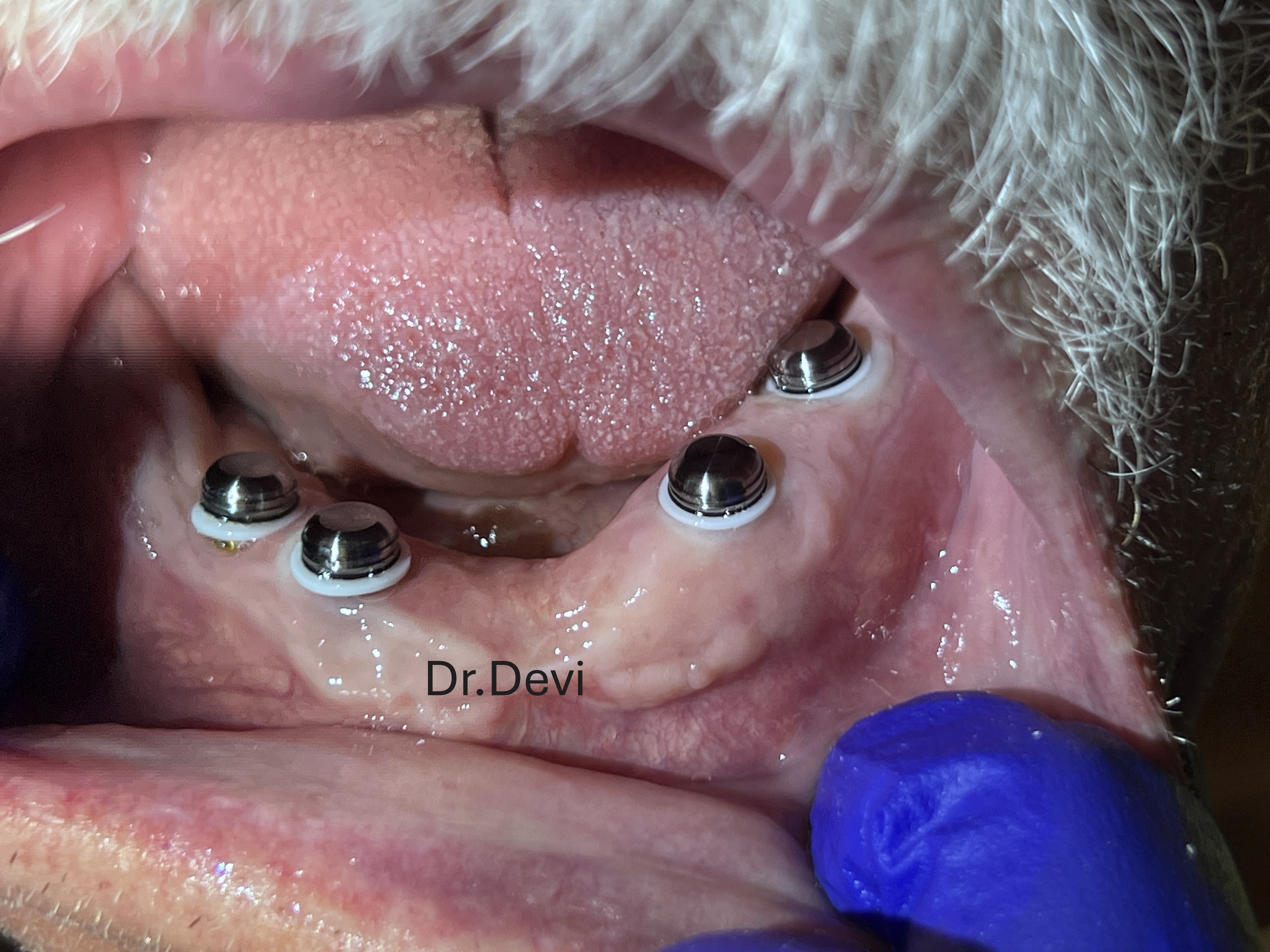 Locators for overdenture