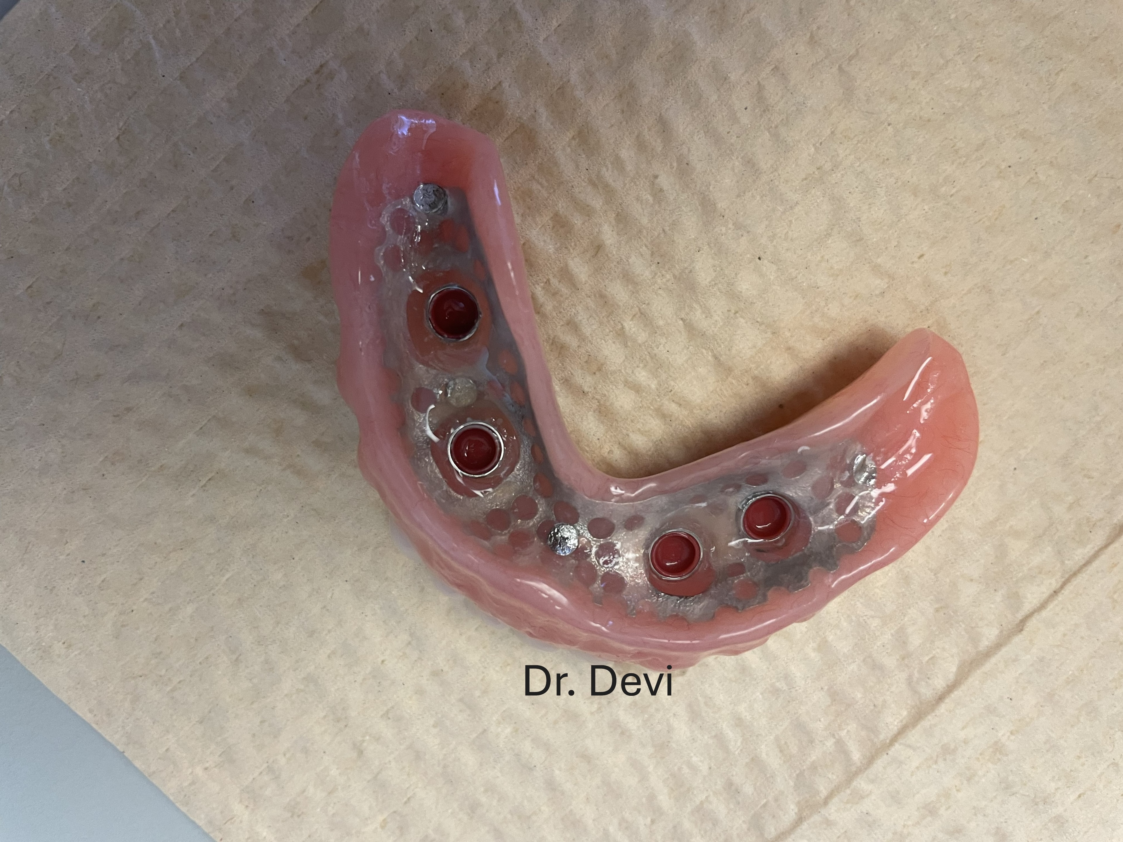 Locator overdenture