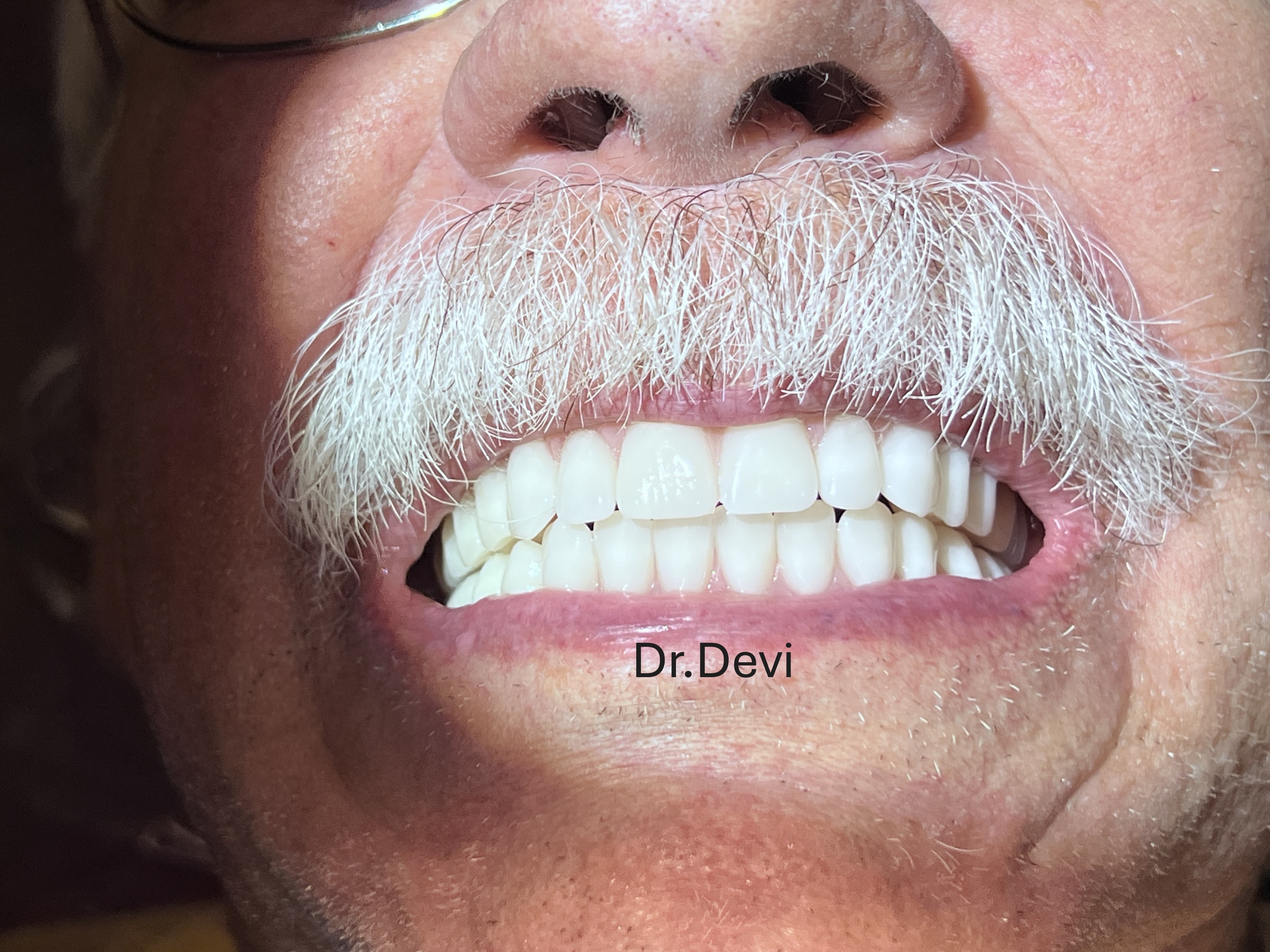 Locator overdenture in place