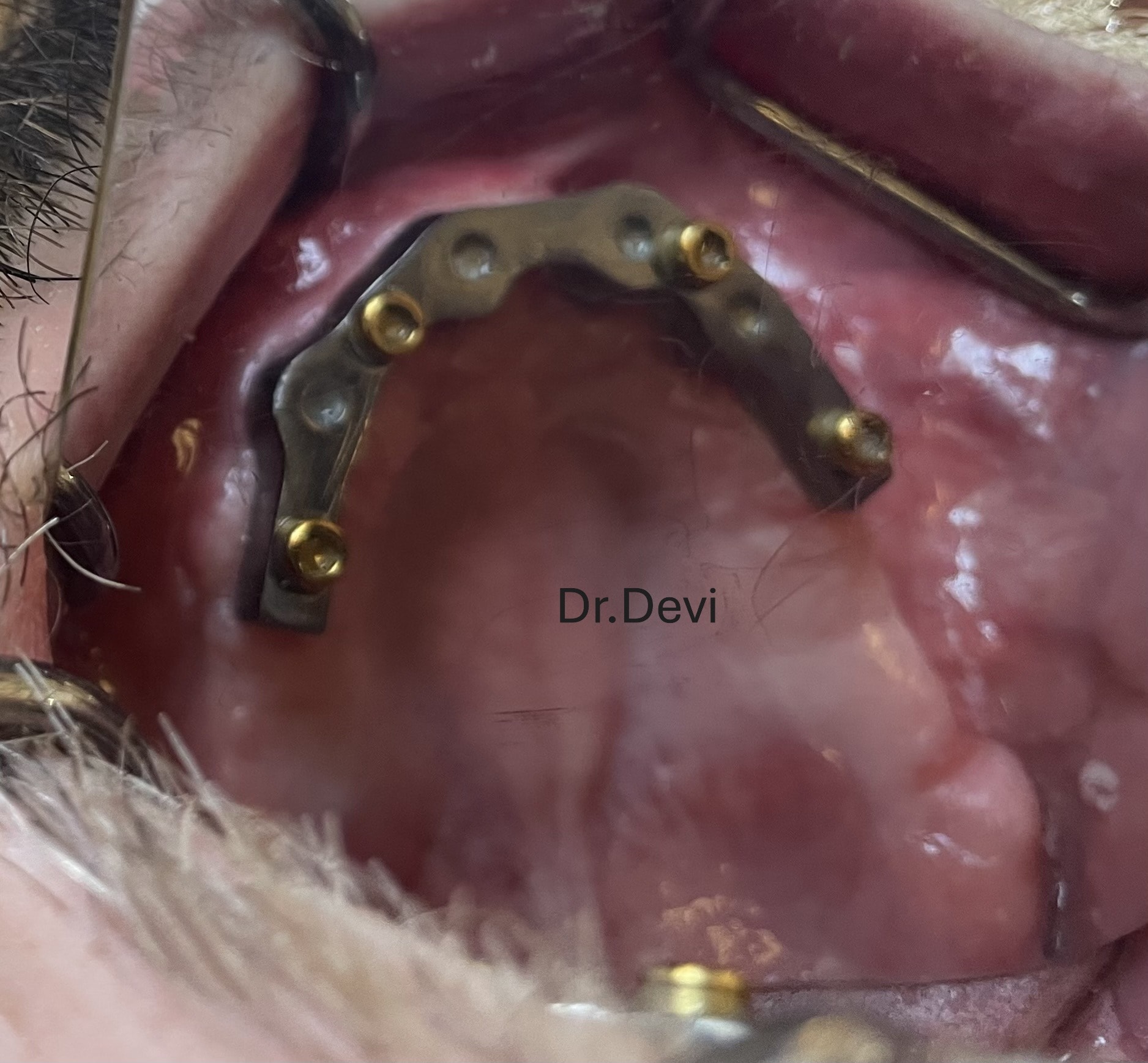 Bar for Upper Overdenture