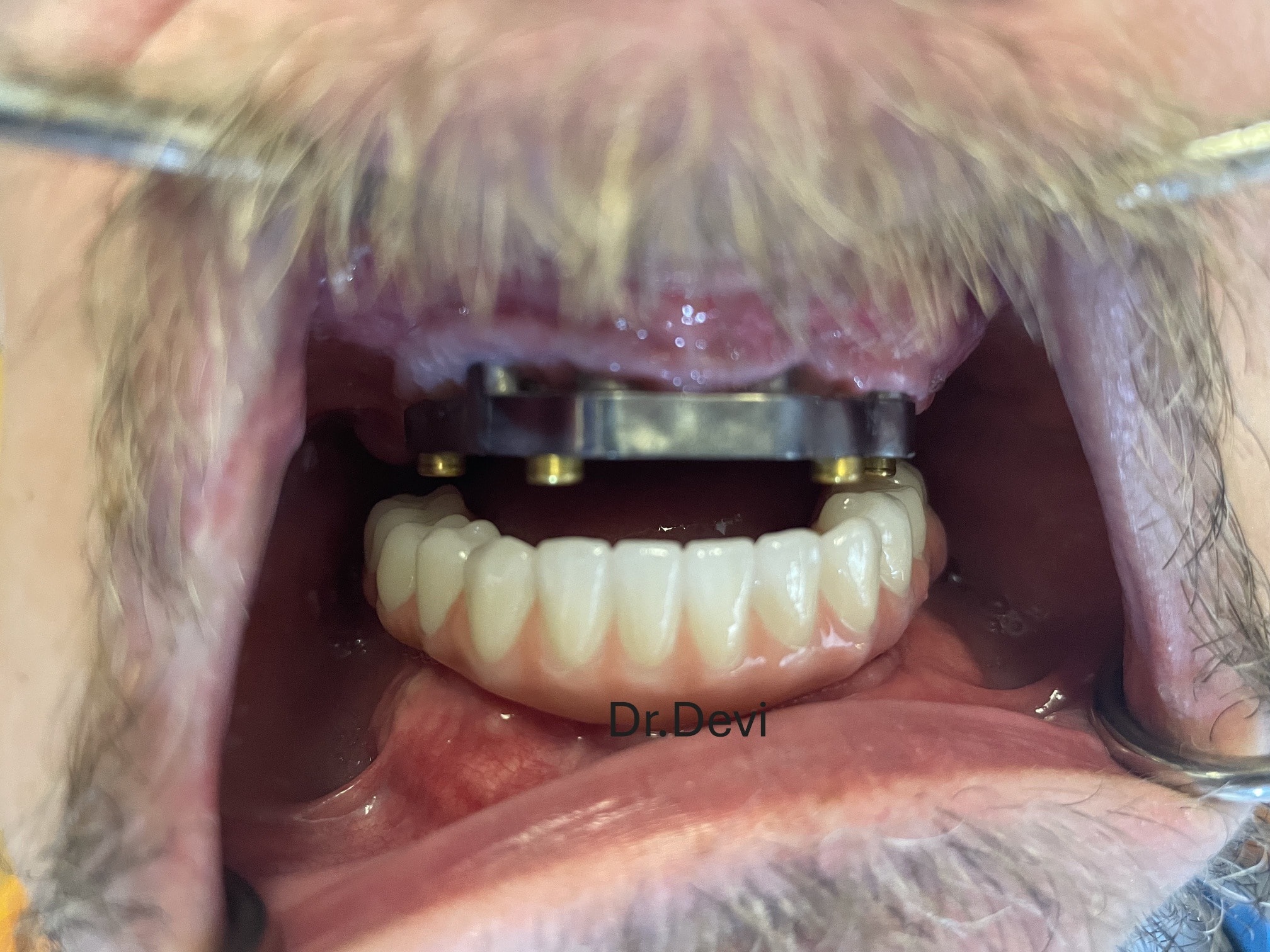 Upper Bar & Lower All-on-6