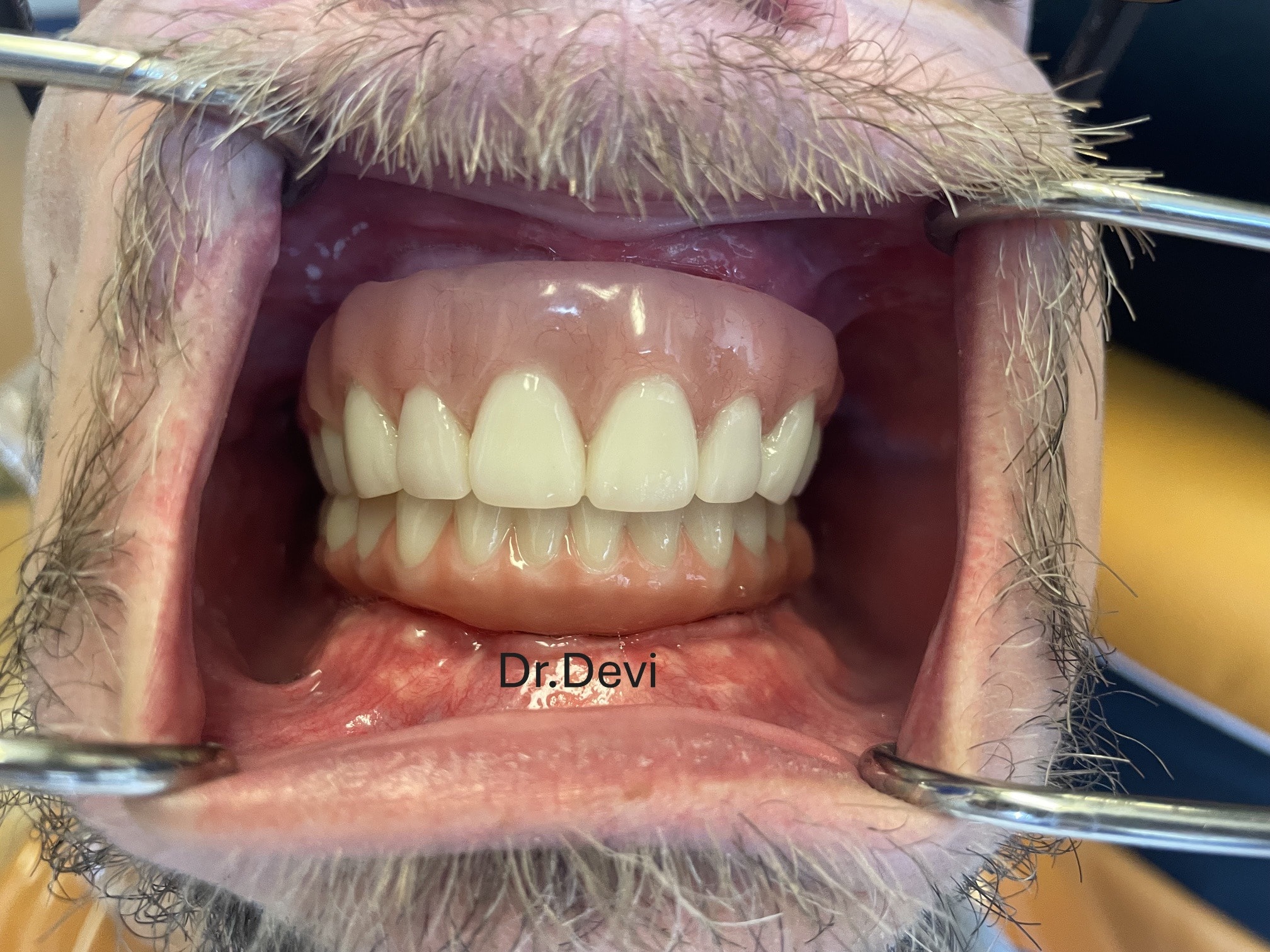 Upper Bar Overdenture & Lower All-on-6