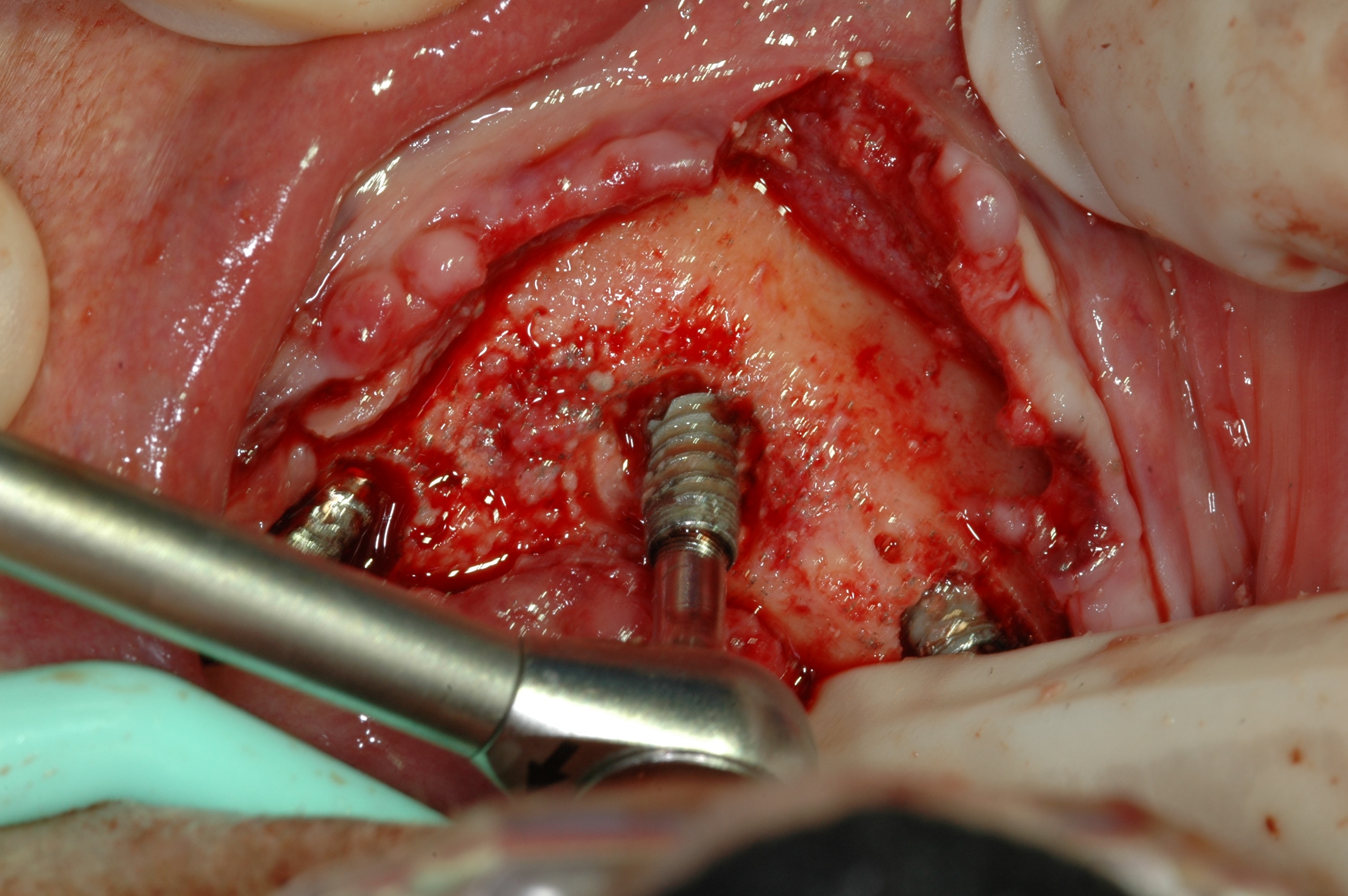 Bone loss around implants