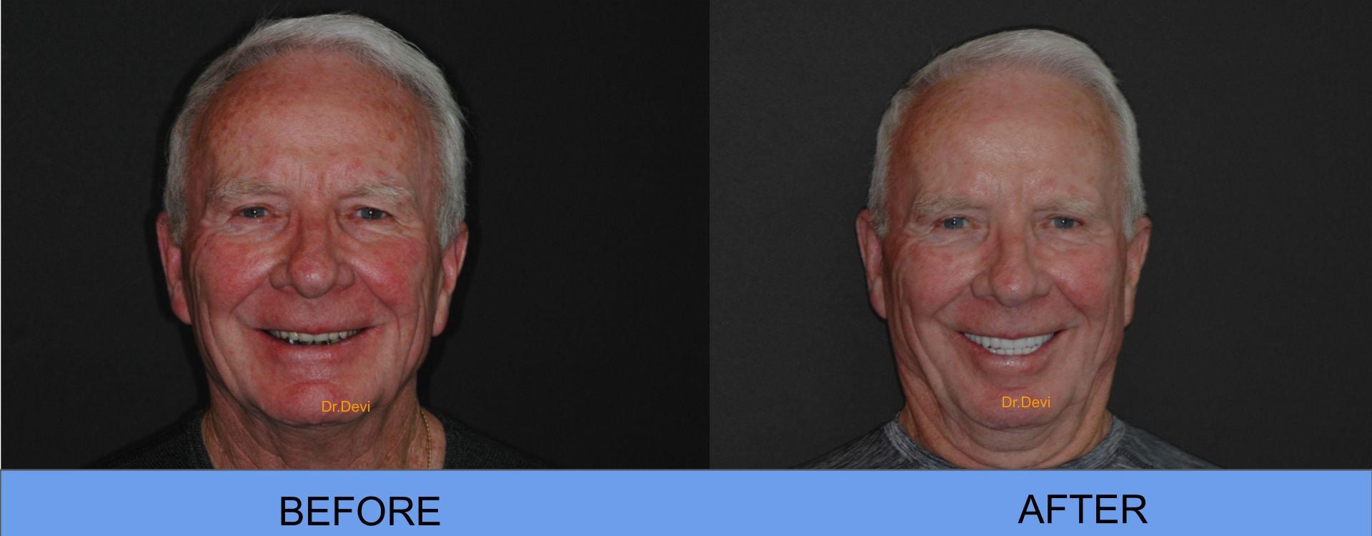 Patient smile transformation