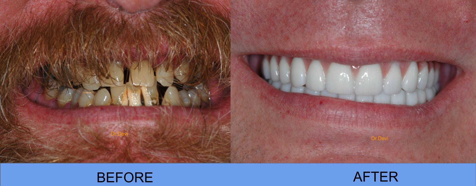 Patient smile transformation