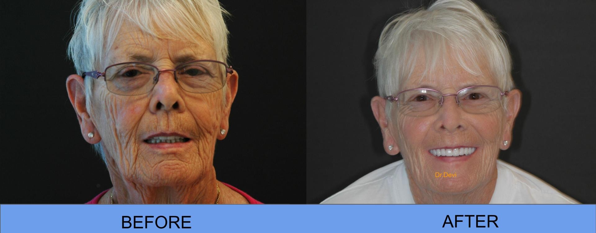 Before and after smile transformation