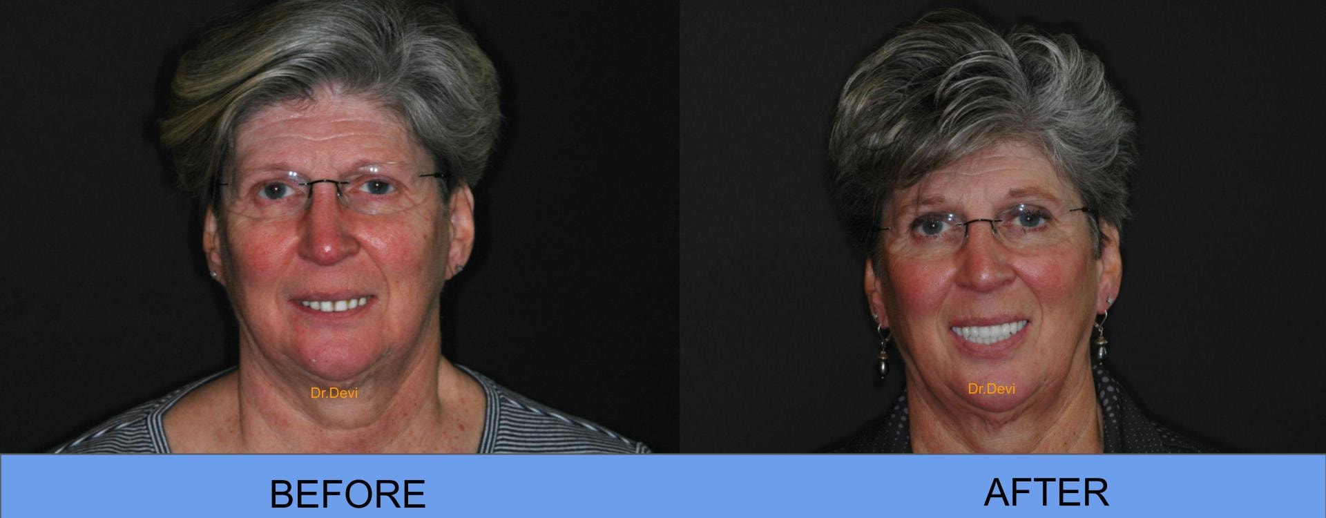 Before and after smile transformation
