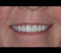 New Smile After Dental Implant