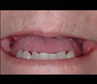 Smile Before Dental Implant