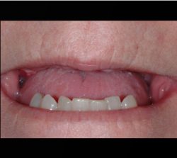 Smile Before Dental Implant