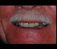 Success Stories of Dental Implants